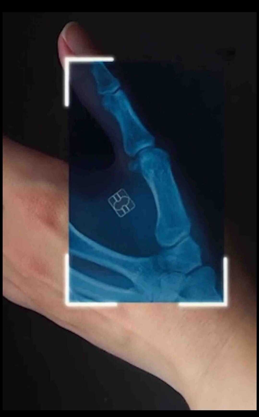 ሰበር       ሙጃሂዶቹ በማረኩት የወራሪዋ ወታደሮች የሰውነት ቆዳ ስር የተቀበ.. | muhsin dino