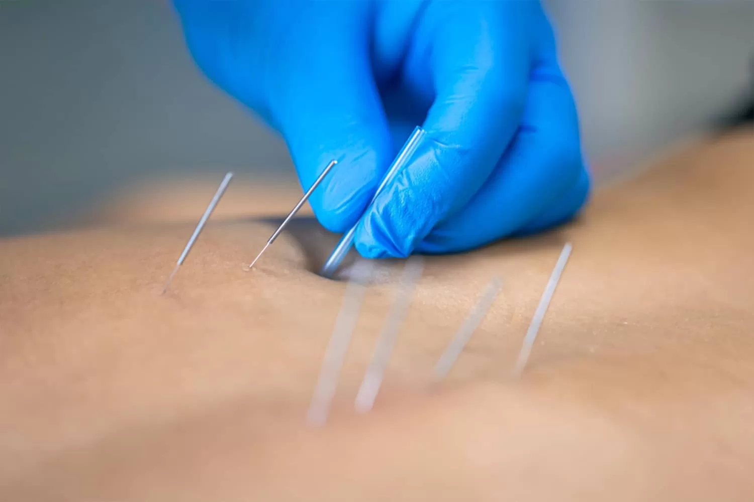 Dry Needling Therapy – Pain Relief & Muscle Recovery